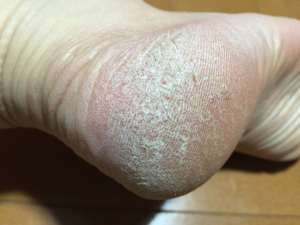 かかとひび割れ　画像